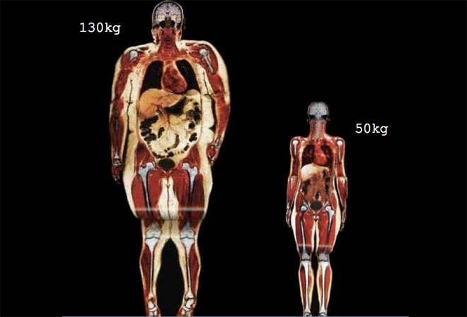 Уменьшение роста и веса человека